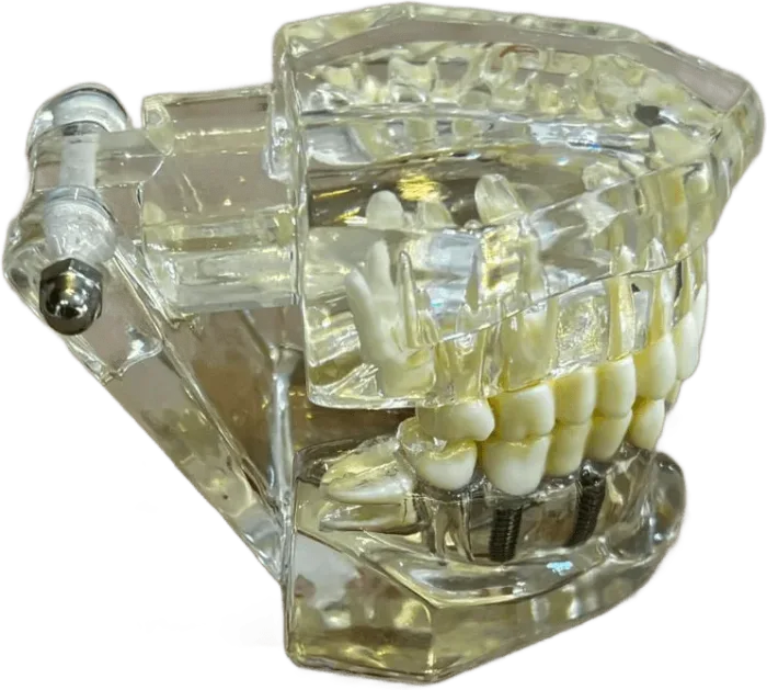 Modelo didático fechado, com os parafusos dos implantes visíveis